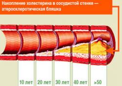 Атеросклеротическая бляшка

